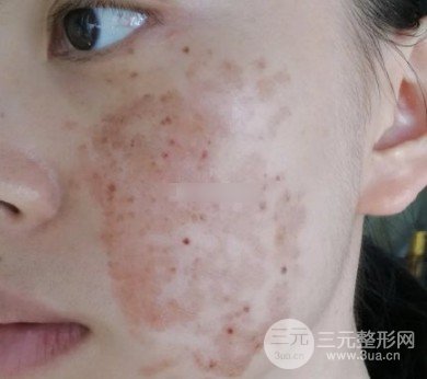激光祛斑價(jià)格解析，探索與影響因素